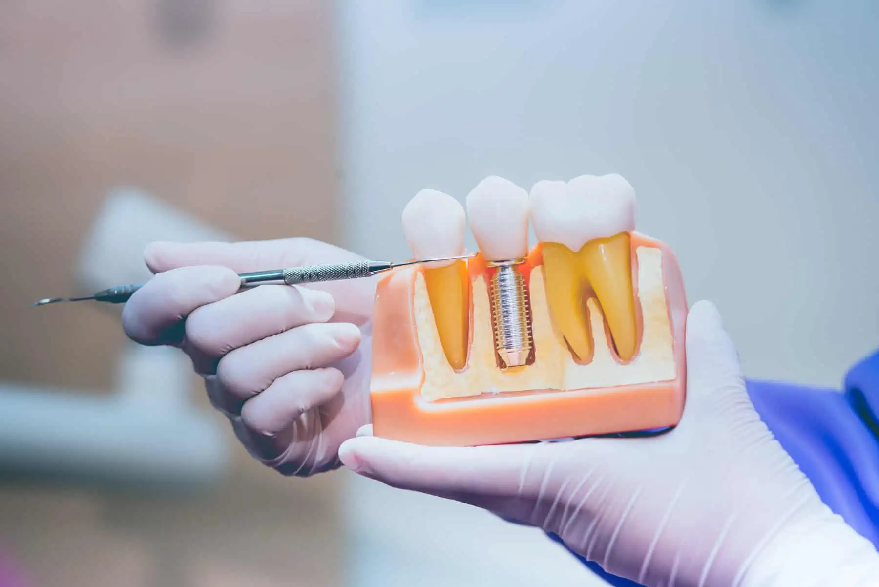 Dental implant consultation at Clear Smile Dental Care