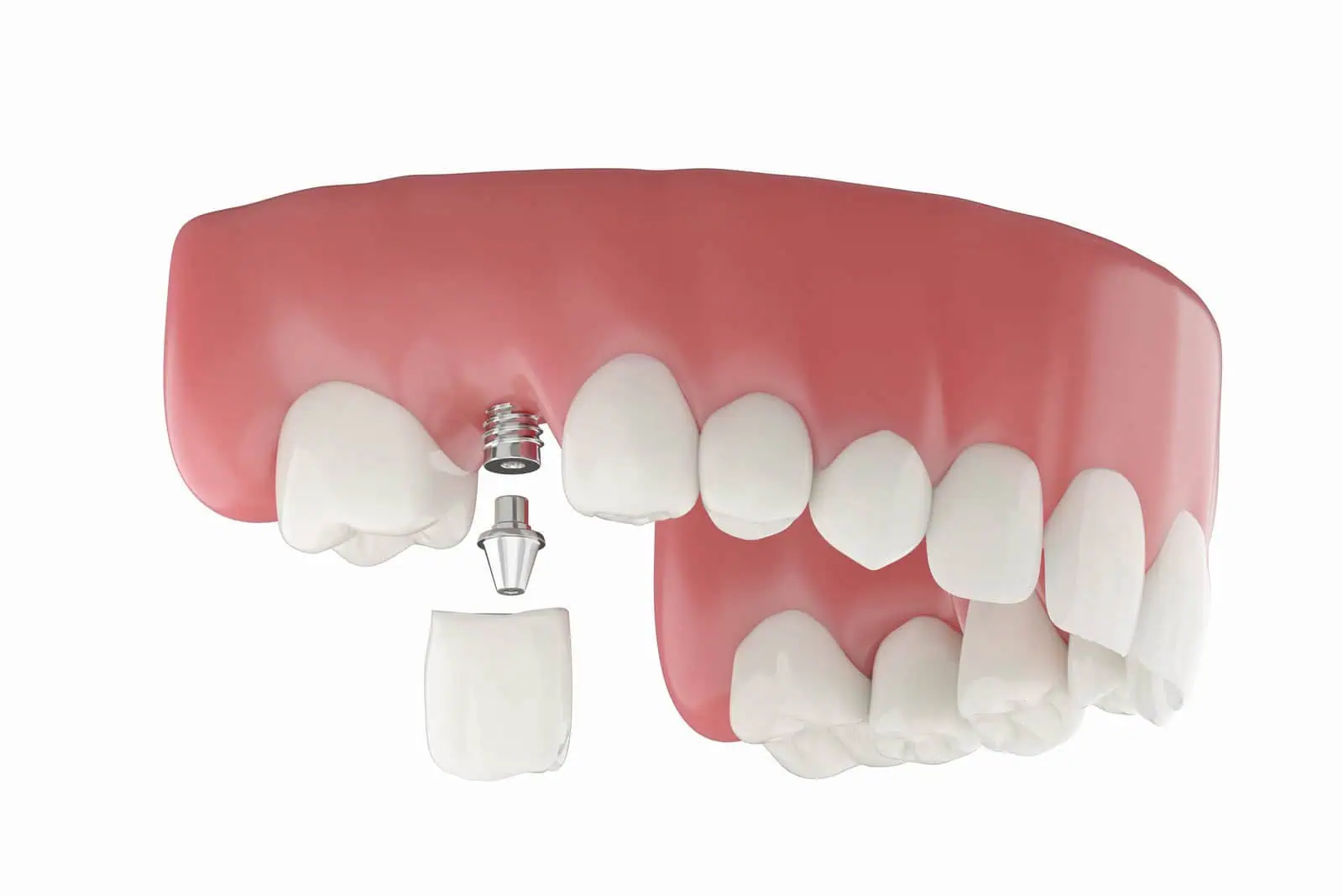 Single tooth dental implant showing titanium post and crown